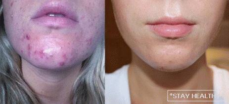 Epiduo Before After Acne